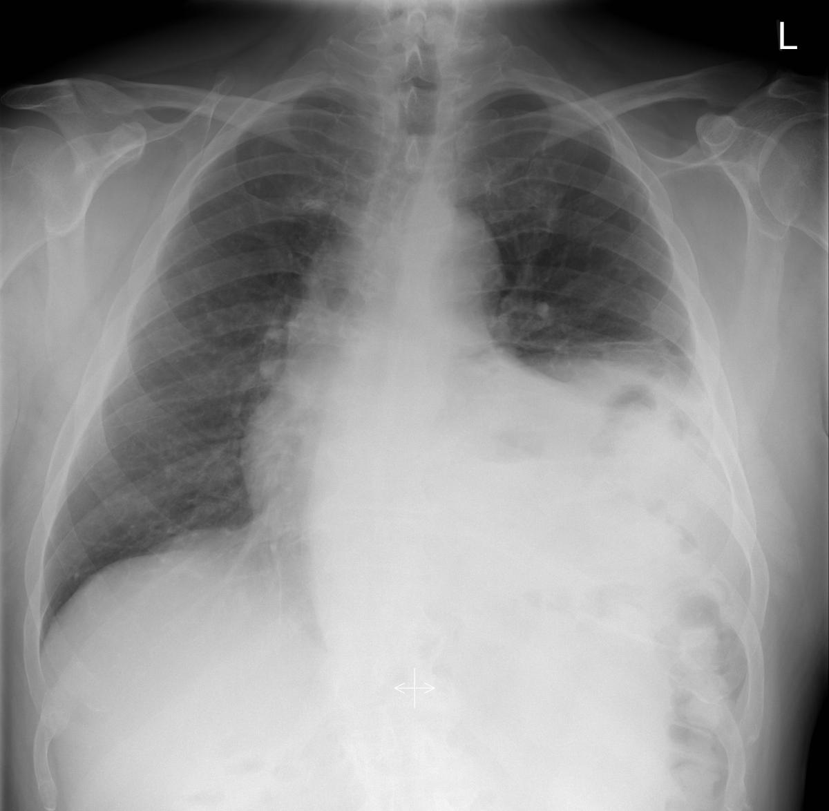 Robotic Diaphragm Plication